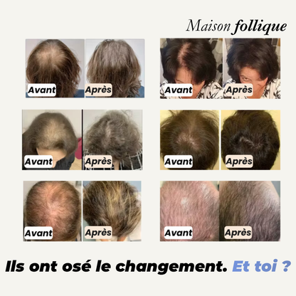 Roll-On Anti-Chute & Repousse — Pour Alopécie et Cheveux Clairsemés