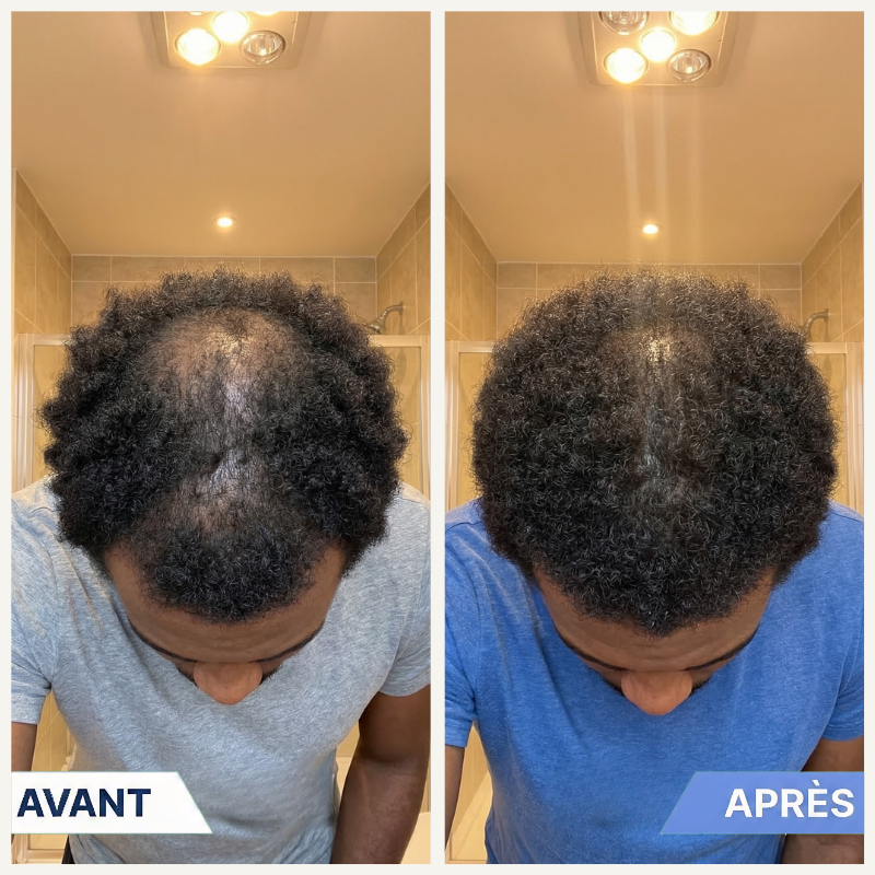 Roll-On Anti-Chute & Repousse — Pour Alopécie et Cheveux Clairsemés