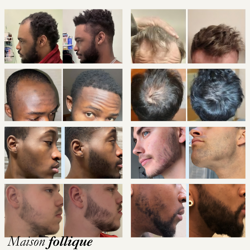 Roll-On Anti-Chute & Repousse — Pour Alopécie et Cheveux Clairsemés