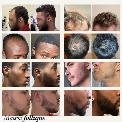 Roll-On Anti-Chute & Repousse — Pour Alopécie et Cheveux Clairsemés